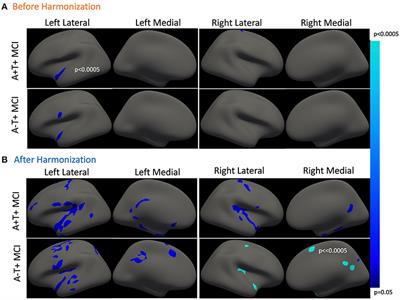 Cross-Sectional and Longitudinal Hippocampal Atrophy, Not Cortical Thinning, Occurs in Amyloid-Negative, p-Tau-Positive, Older Adults With Non-Amyloid Pathology and Mild Cognitive Impairment